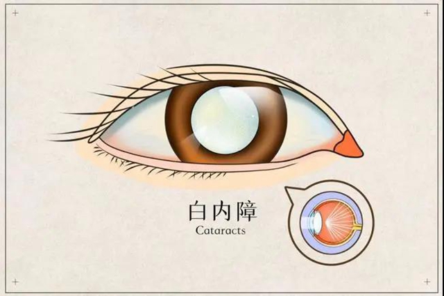 【提醒】躲不過的白內(nèi)障，究竟何時(shí)做才最有效？