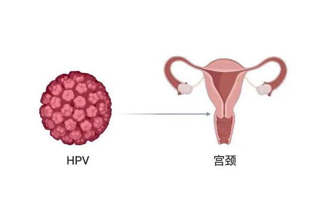 【擴(kuò)散】感染了HPV病毒，就是得了宮頸癌？