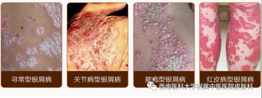 【圍觀】大媽全身瘙癢起紅斑，還脫皮！(圖6)