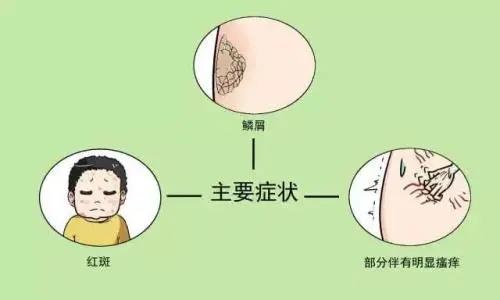 【圍觀】大媽全身瘙癢起紅斑，還脫皮！(圖7)