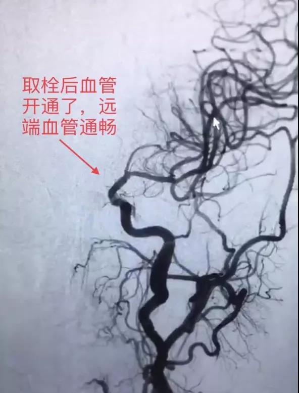 轉(zhuǎn)發(fā)可以救命！中風(fēng)急救，抓住黃金4.5小時(shí)(圖4)