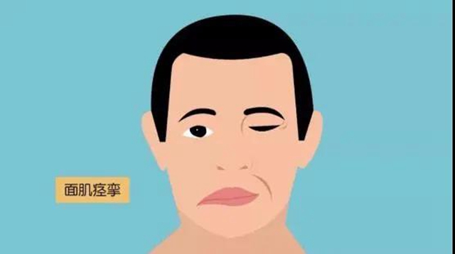 【關(guān)注】左眼跳財，右眼跳災(zāi)？可能是面痙攣！(圖4)