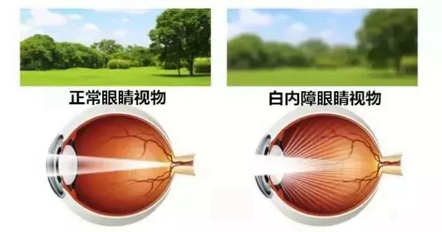 【技術(shù)】小切口大智慧—合江縣中醫(yī)醫(yī)院開展首例白內(nèi)障手術(shù)！(圖7)