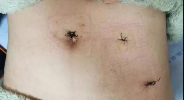 肚臍“下刀”，婦科手術不留疤！瀘州市人醫(yī)婦科開展經臍入路單孔腹腔鏡手術(圖3)